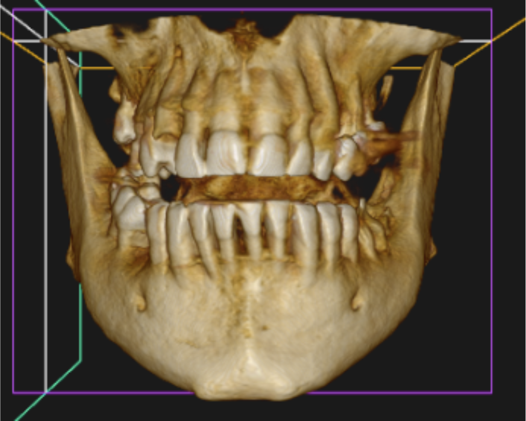 CDCT1 Escáner 3D dental (CBCT) - Tecnología de tomografía computarizada