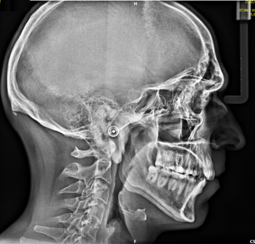 TelerradiografiaLateralCraneo Relerradiografía lateral de cráneo